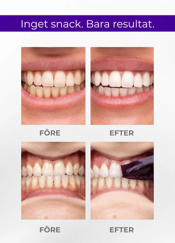 Tandblekningsstrips - Whitening Patches