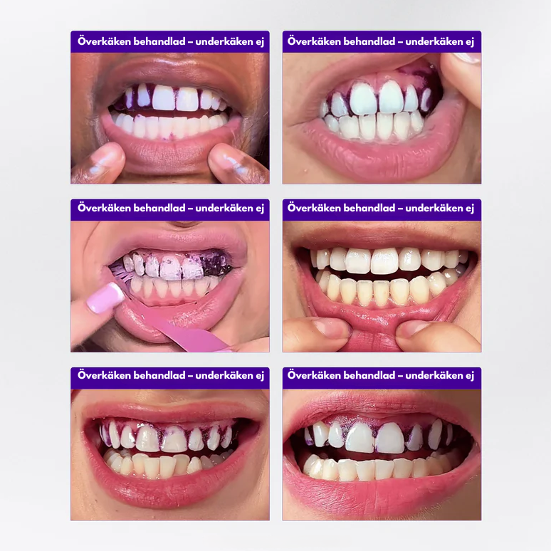 Tandblekningsstrips - Whitening Patches
