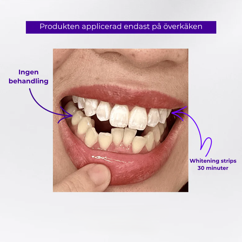 Tandblekningsstrips - Whitening Patches